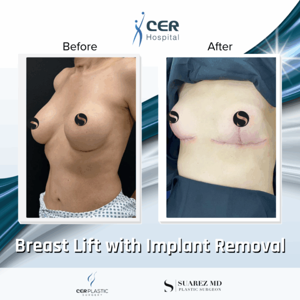 Breast Lift with Implant Removal - 14104