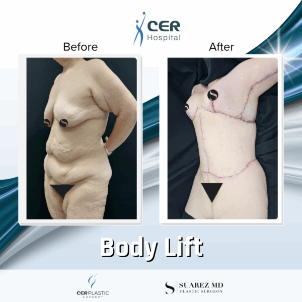 Body Lift - 24104 - Image 8