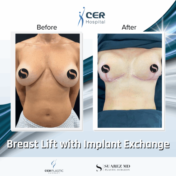 Breast Lift with Implant Exchange - 28104 - Image 7