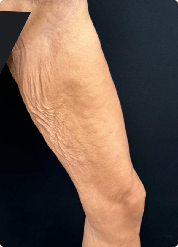 Extended Thigh Lift - 30104 - Image 3