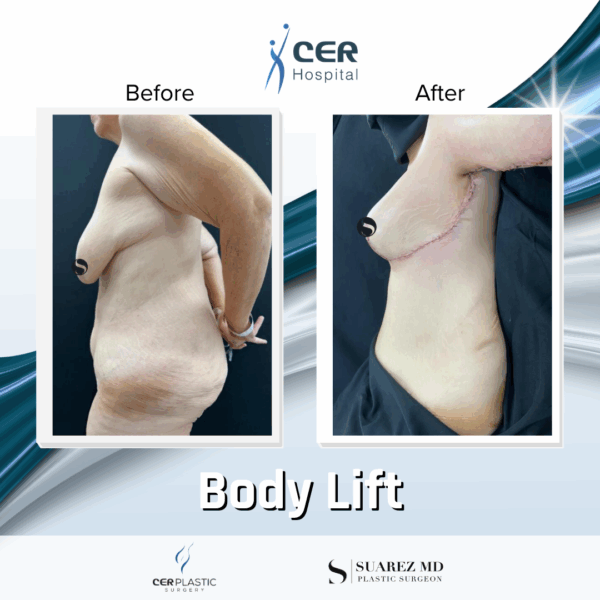 Body Lift - 10124