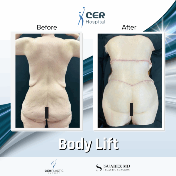 Body Lift - 18124 - Image 7