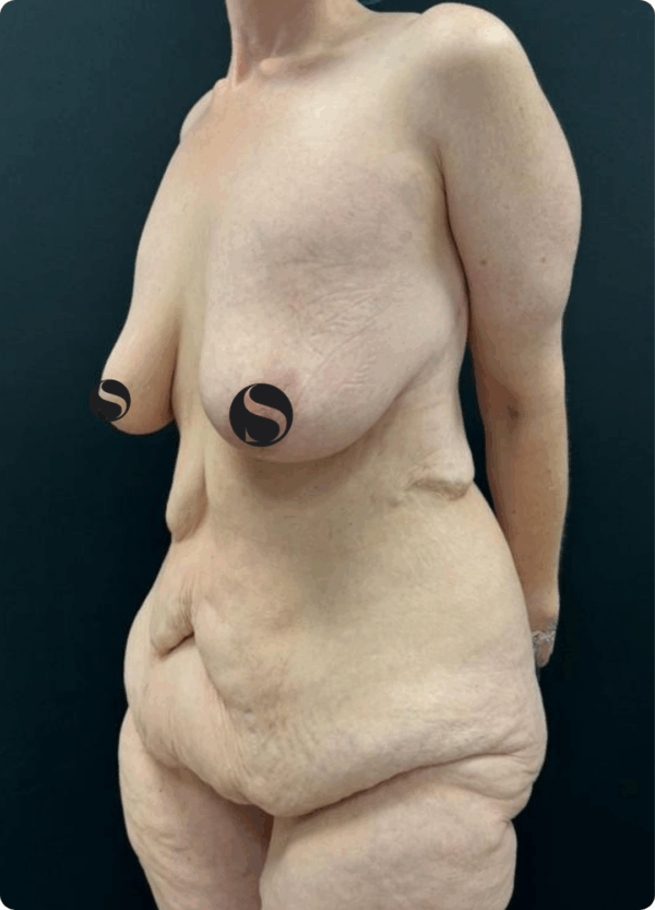 Body Lift - 18124 - Image 3
