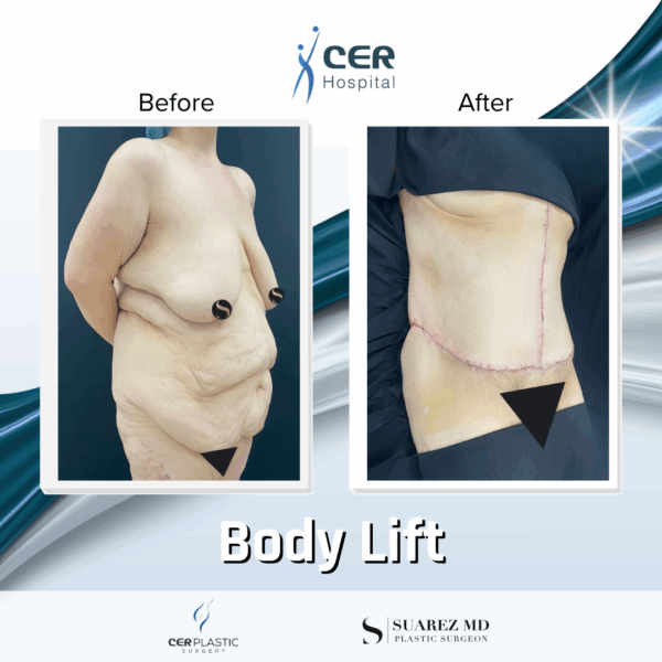 Body Lift - 7013