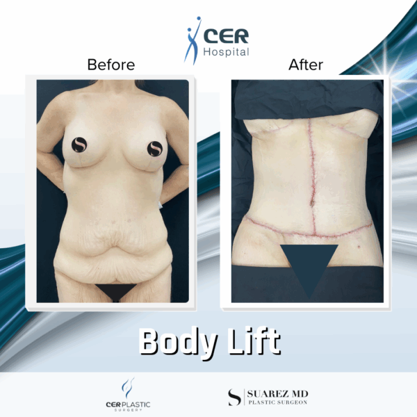 Body Lift - 8013 - Image 8