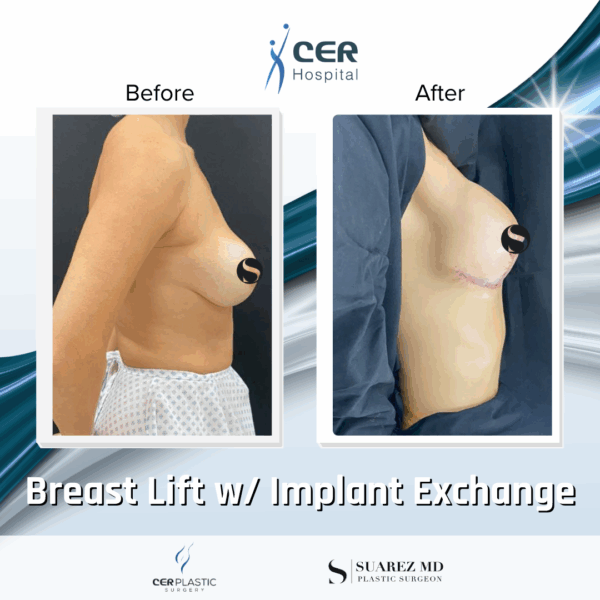 Breast Lift with Implant Exchange - 9013 - Image 7