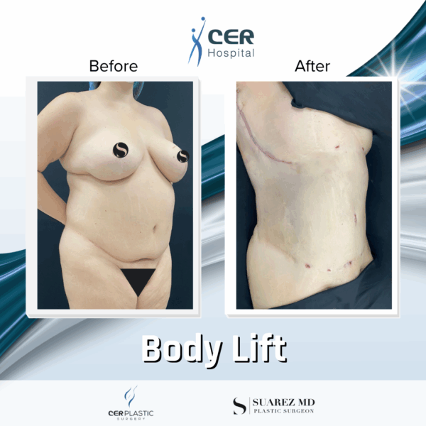 Body Lift - 11013 - Image 7