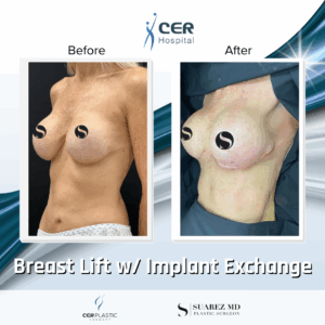 Breast Lift with Implants – 13013