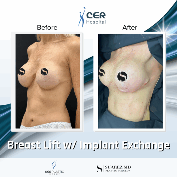 Breast Lift with Implants - 13013