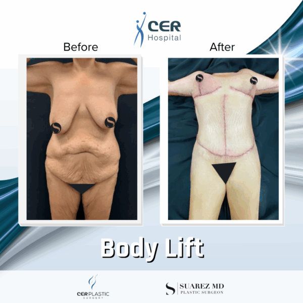 Body Lift - 31074 - Image 7