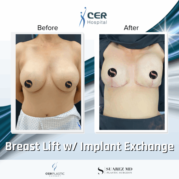 Breast Lift with Implant Exchange - 16013 - Image 7