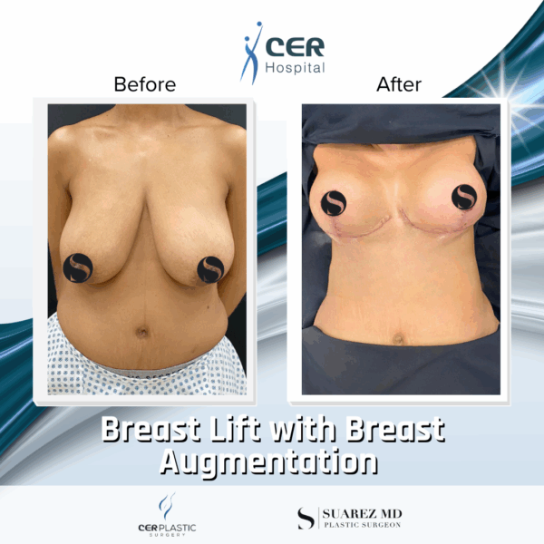 Breast Lift & Breast Augmentation - 16013