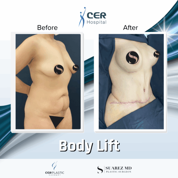 Body Lift - 18013 - Image 7