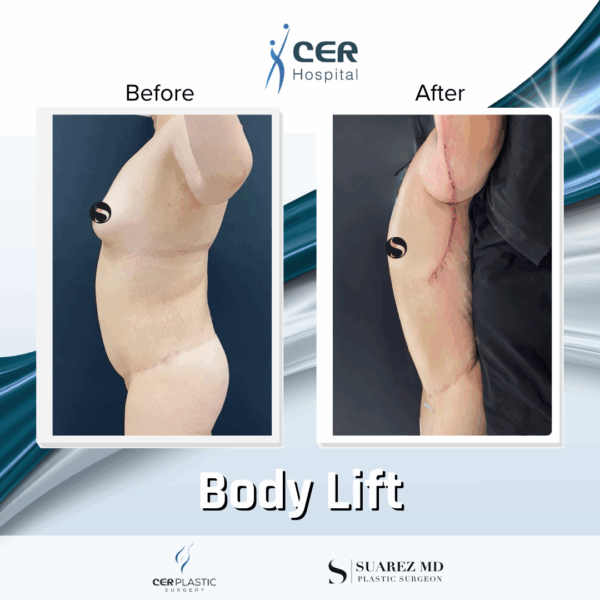 Body Lift - 20013 - Image 8