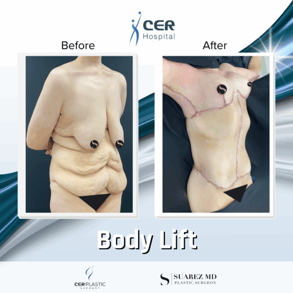 Body Lift - 20013