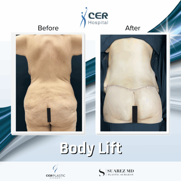 Body Lift - 23013 - Image 7