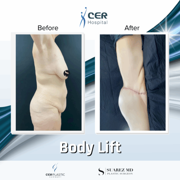 Body Lift - 13121 - Image 7