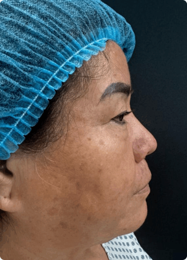 Eyelid Surgery - 5084 - Image 3