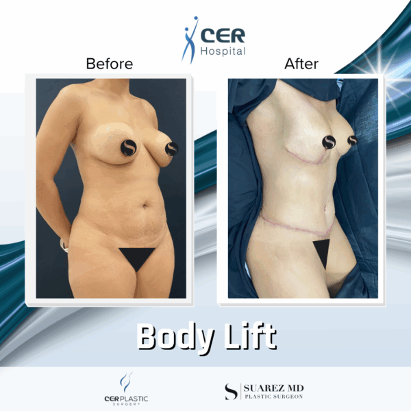 Body Lift - 26043 - Image 7