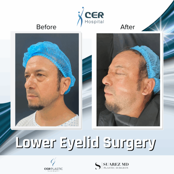 Lower Eyelid Surgery - 21043 - Image 7