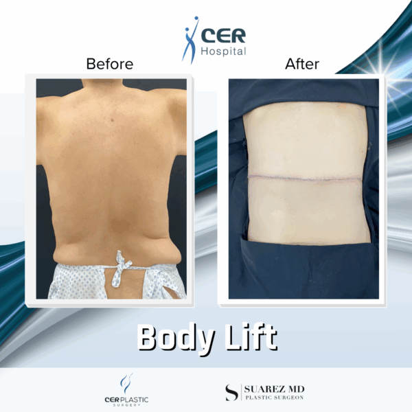 Body Lift - 10043 - Image 8