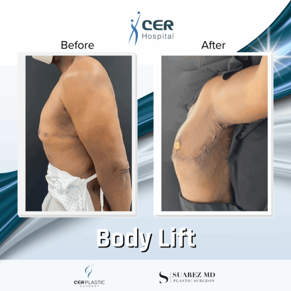 Body Lift - 19043 - Image 8