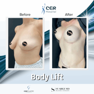 Body Lift – 5043