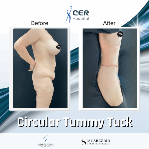 Circular Tummy Tuck - 3043 - Image 7