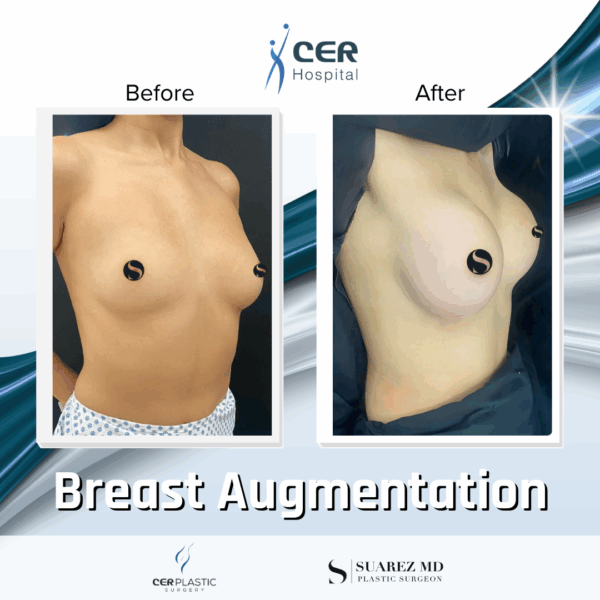 Breast Augmentation - 31053 - Image 7