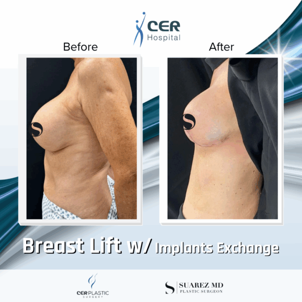 Breast Lift with Implant Exchange - 26084 - Image 7
