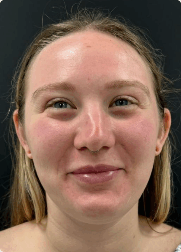 Otoplasty - 4094 - Image 3