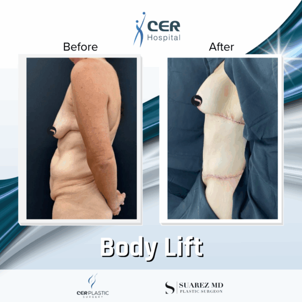 Body Lift - 9104 - Image 4