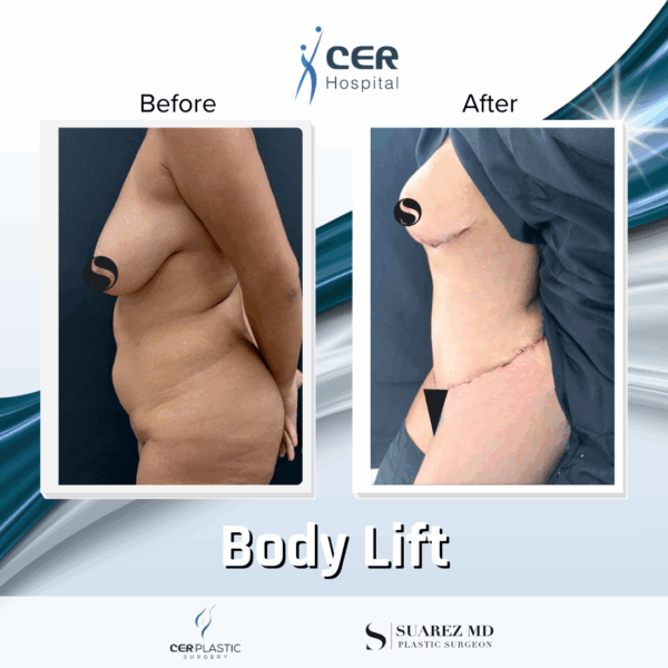 Body Lift - 20084 - Image 8