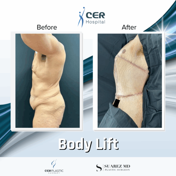 Body Lift - 3074 - Image 8