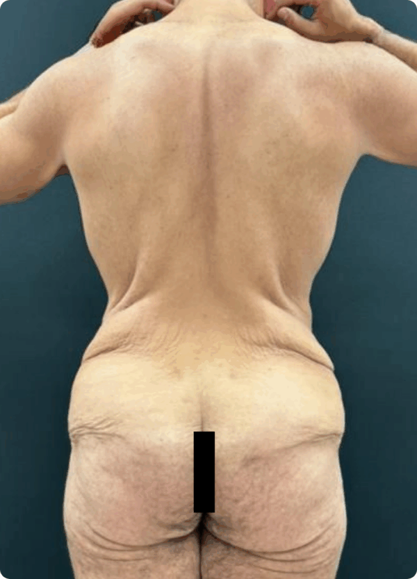 Body Lift - 3074 - Image 3