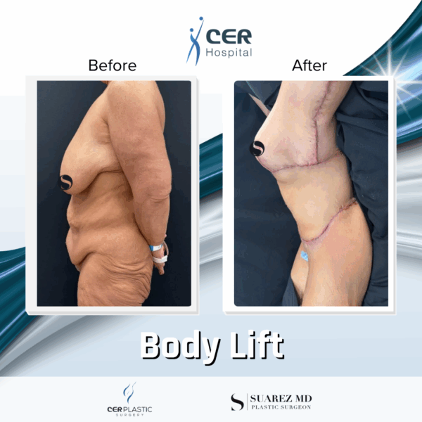 Body Lift - 0608 - Image 8