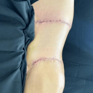 Body Lift – 0608