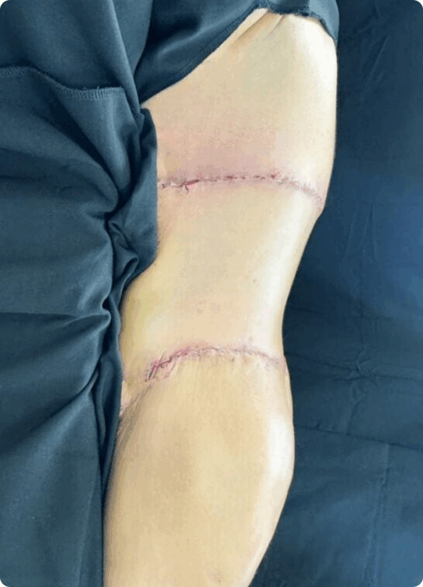 Body Lift - 0608 - Image 2