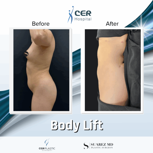 Body Lift - 22054 - Image 8
