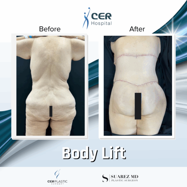 Body Lift - 24104 - Image 9