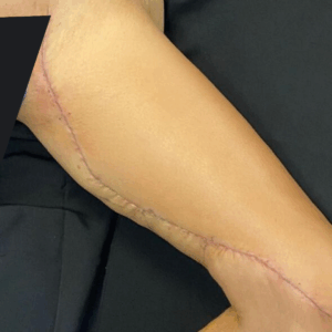 Extended Thigh Lift – 30104