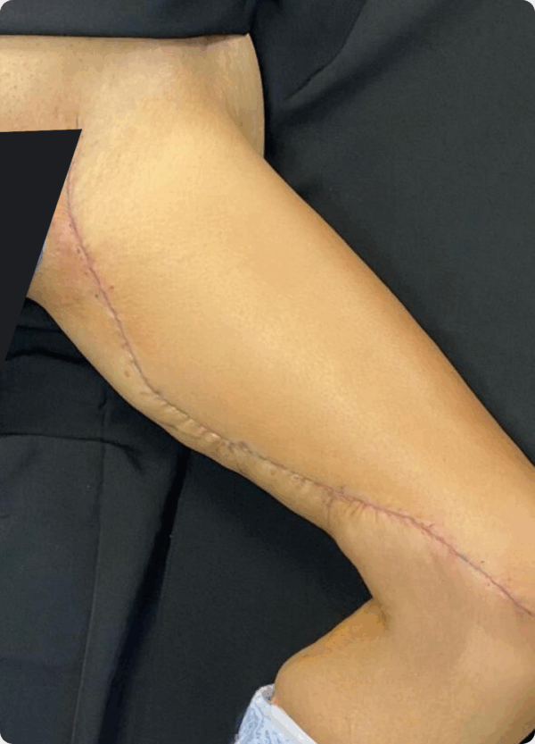Extended Thigh Lift - 30104 - Image 2