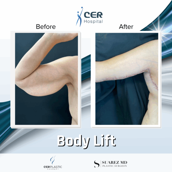 Body Lift - 10124 - Image 8