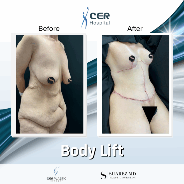 Body Lift - 18124 - Image 8