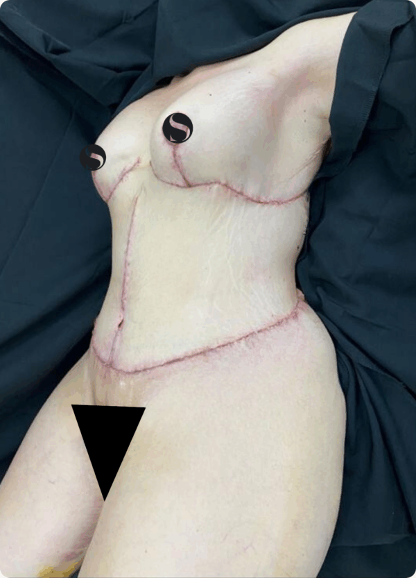 Body Lift - 18124 - Image 2