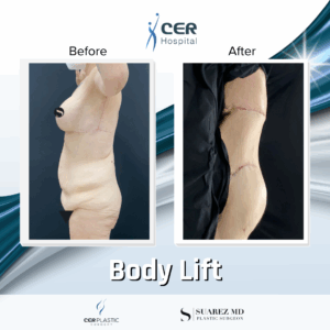 Body Lift – 8013