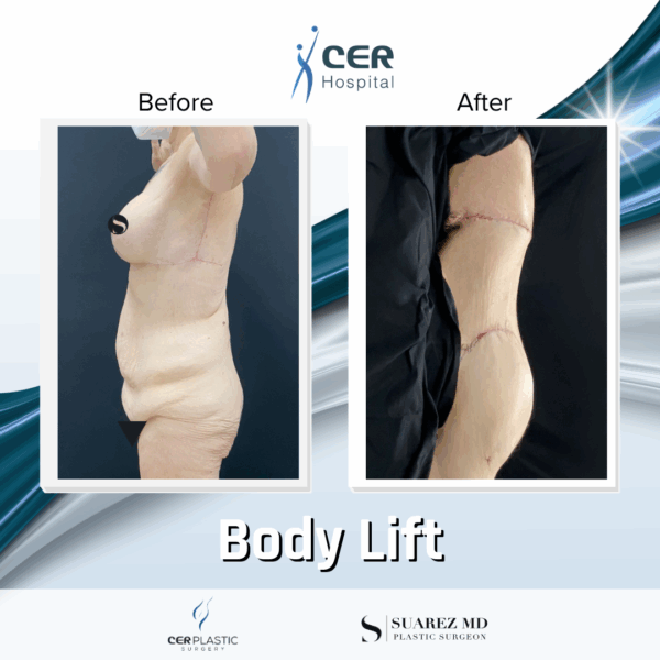 Body Lift - 8013