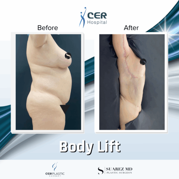 Body Lift - 11013 - Image 8