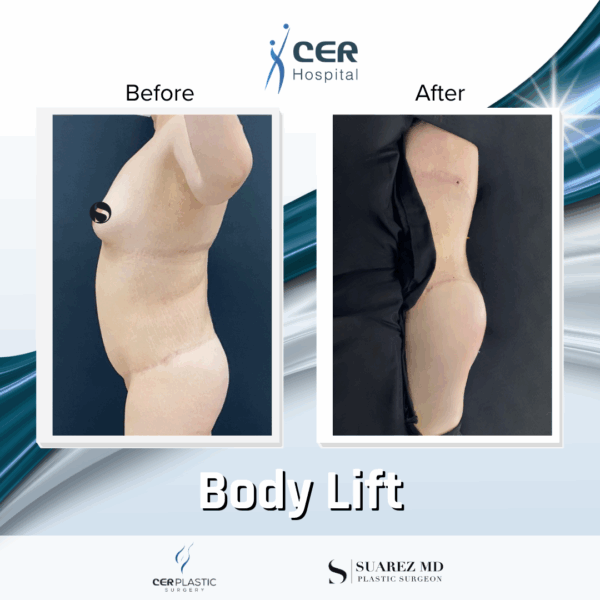 Body Lift - 20013 - Image 9