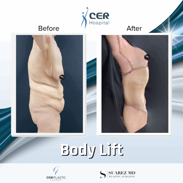 Body Lift - 20013 - Image 8